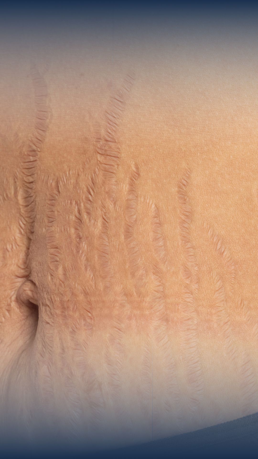 STRECH-MARKS-av-beauty-LOWER STONDON