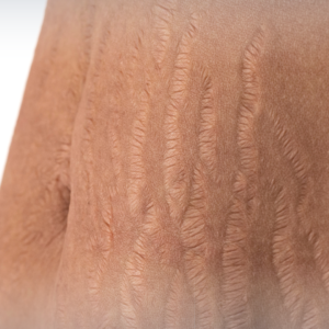 Stretch Marks Camouflage Course (with Microneedling)