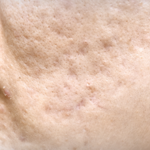 Scar Camouflage Course (with Microneedling)