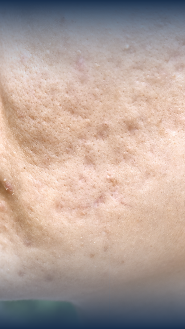 Scar Camouflage Course (with Microneedling)